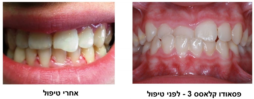 מנשך לפני טיפול ואחרי טיפול