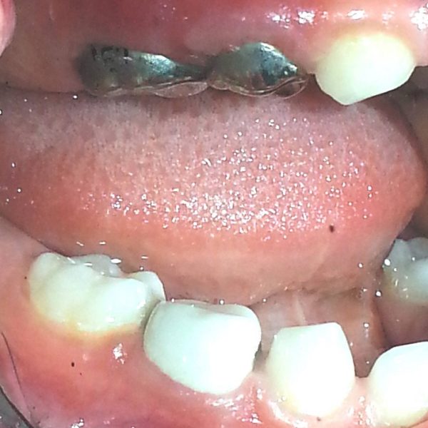 כתרי SSS מול כתרים לבנים כתרי SSS מול כתרים לבנים